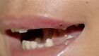 Garota de programa perde dente ao ser agredida por 'cliente'  