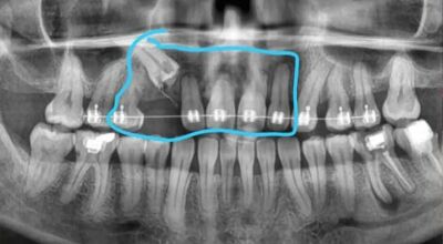 Moradora cria rifa para tratamento de arcada dentária com perda óssea em MS