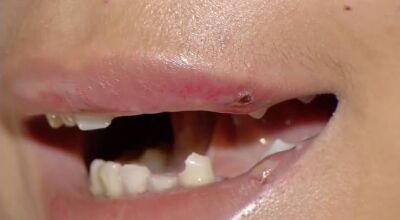 Garota de programa perde dente ao ser agredida por 'cliente'  