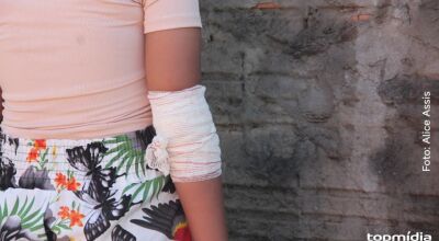 Adolescente quase tem bra&ccedil;o quebrado pelo pai durante festa  