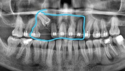 Moradora cria rifa para tratamento de arcada dentária com perda óssea em MS