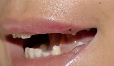 Garota de programa perde dente ao ser agredida por 'cliente'  