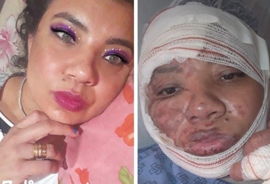 Antes e depois de vítima de queimadura (Foto: reprodução / Rádio Caçula)