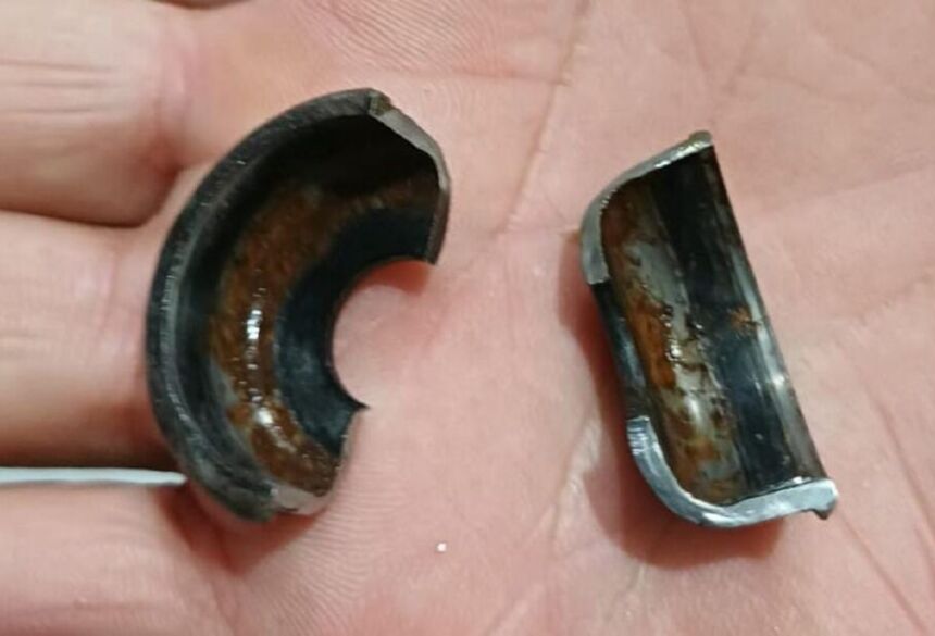  A peça, feita de aço, ficou presa e provocou inchaço e dor, deixando a menina bastante assustada